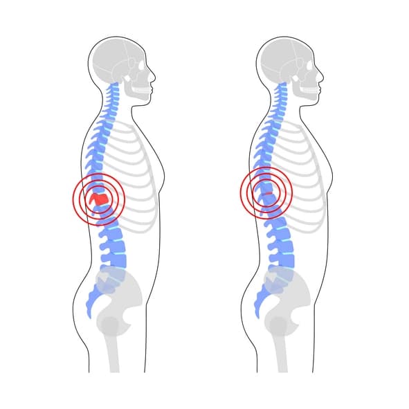 Ankylosing spondylitis spinal treatment illustration