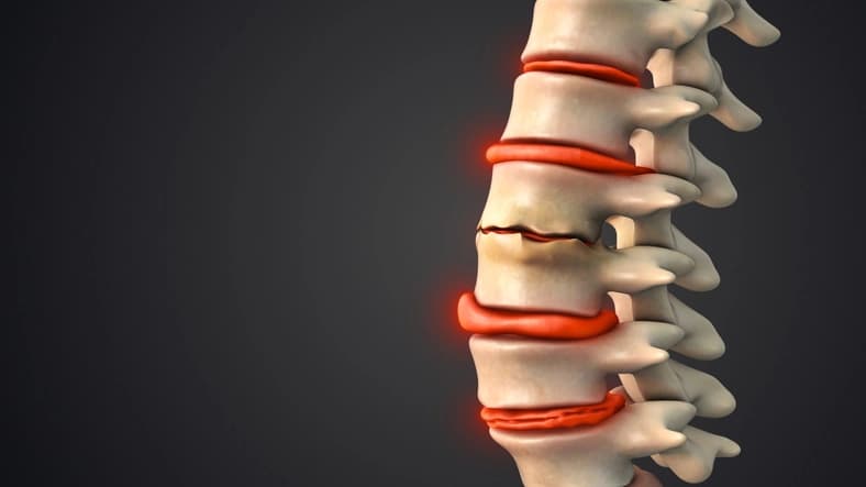 Degenerative disc disease treatment illustration