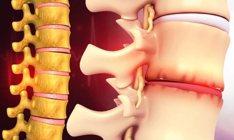 Disc bulge treatment illustration
