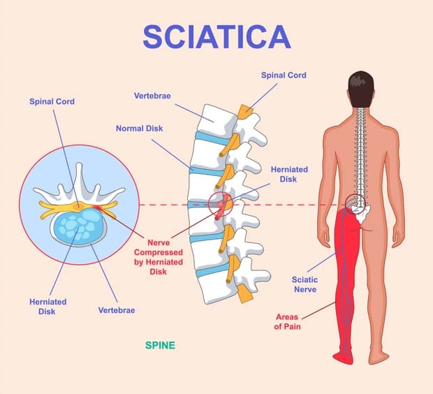 Sciatica pain treatment illustration