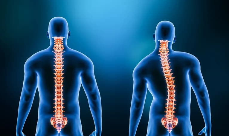 Scoliosis spinal curvature treatment illustration