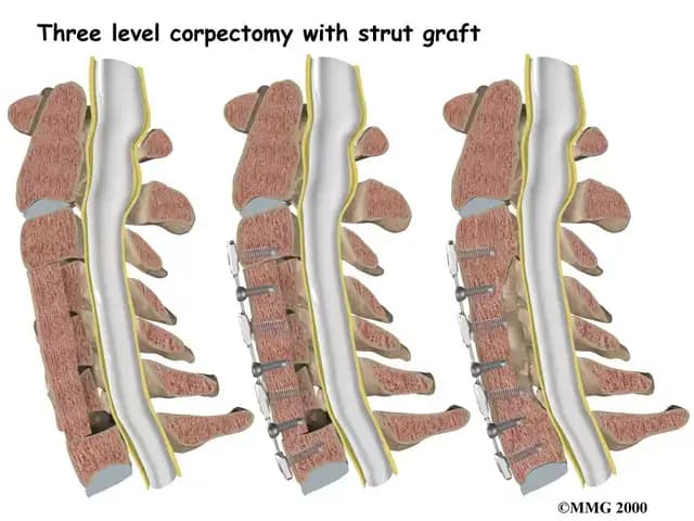 Cervical spinal canal stenosis treatment illustration