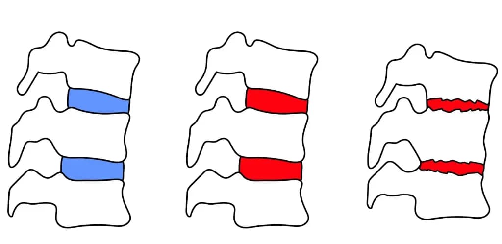 Spondylitis treatment illustration