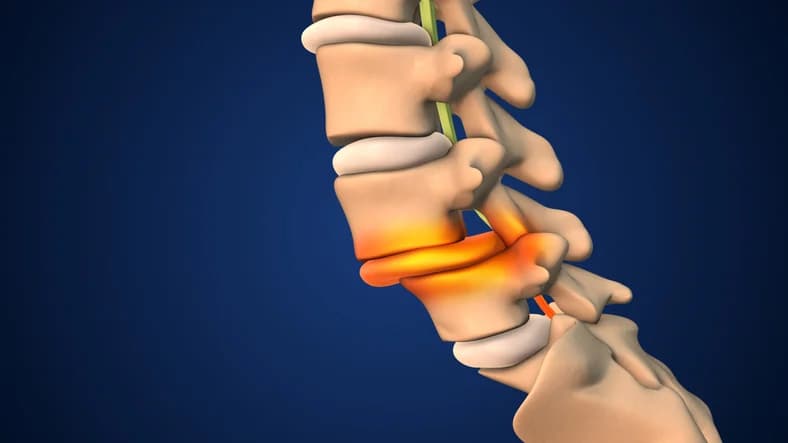 Spondylolisthesis treatment illustration