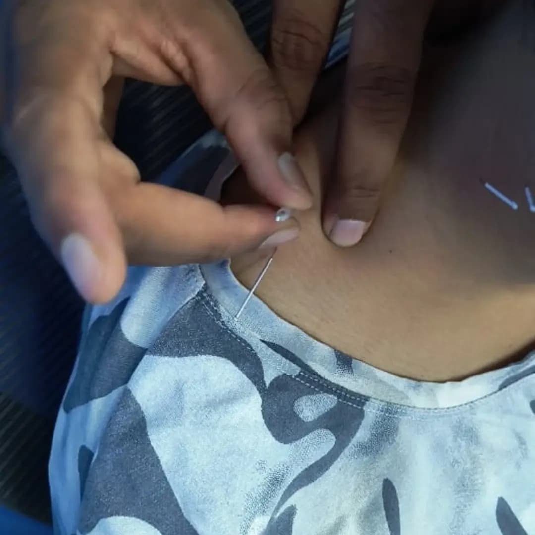 Dry Needling