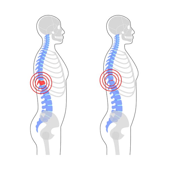 Ankylosing Spondylitis