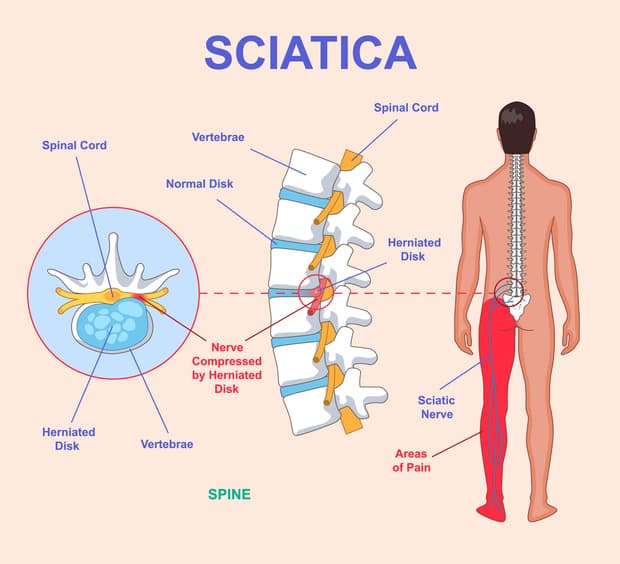 Sciatica