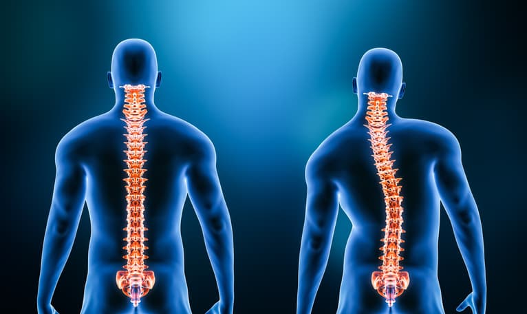 Scoliosis