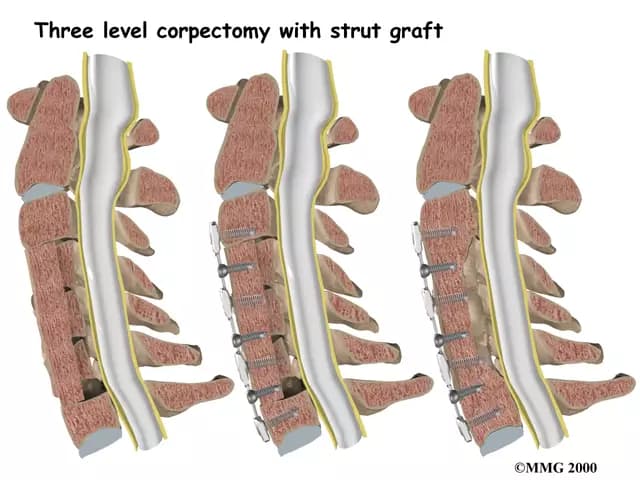Spinal Canal Stenosis
