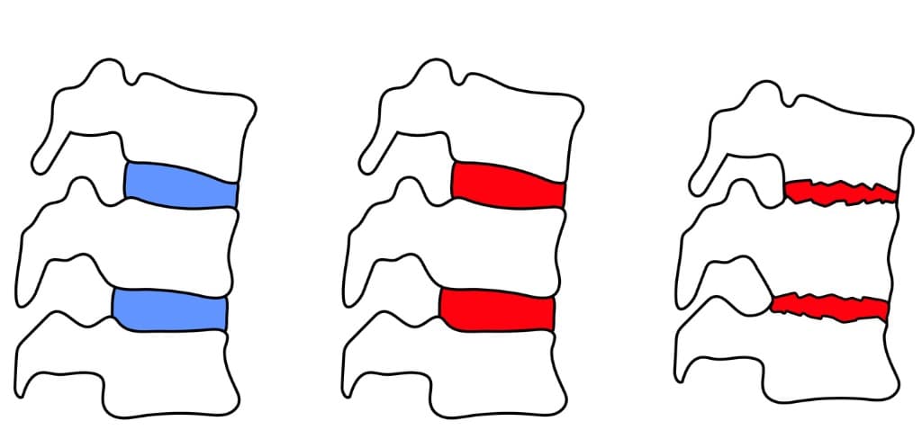 Spondylitis