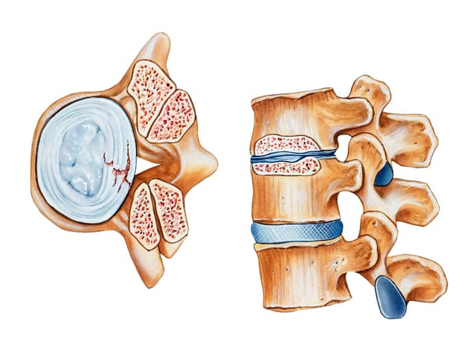 Stenosis