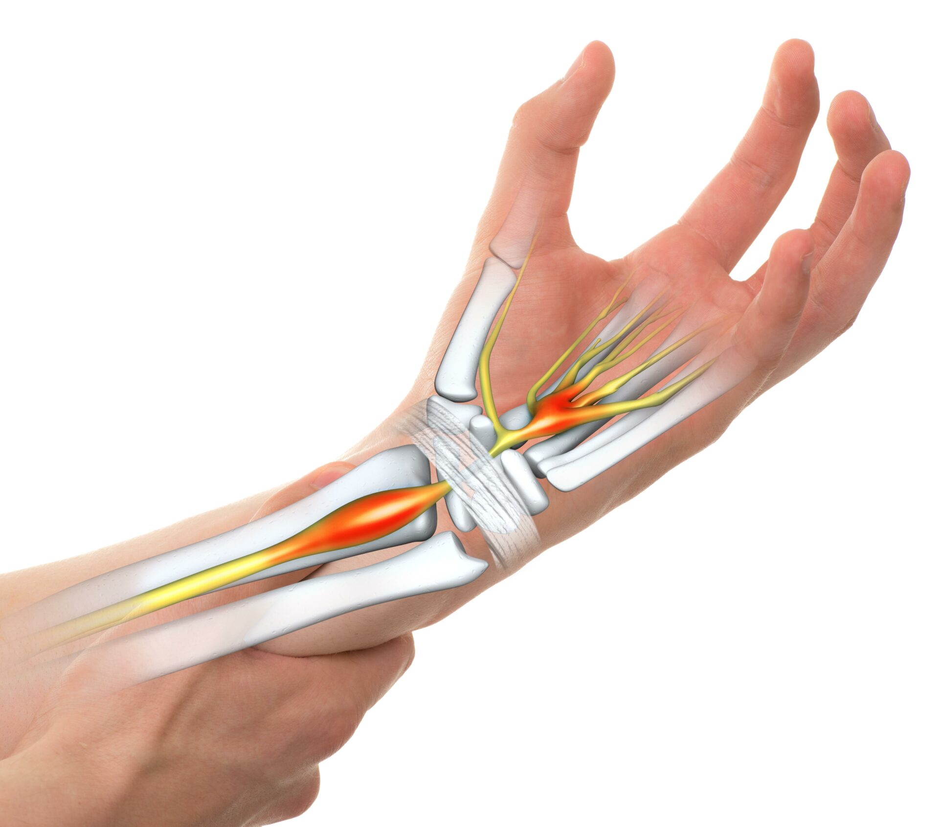 Heal Carpal Tunnel Naturally Yoga & Physiotherapy Techniques