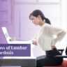 Loss of Lumbar Lordosis