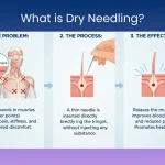 Dry-Needling-Therapy