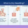 Dry-Needling-Therapy