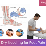 Dry Needling for Foot Pain