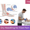 Dry Needling for Foot Pain