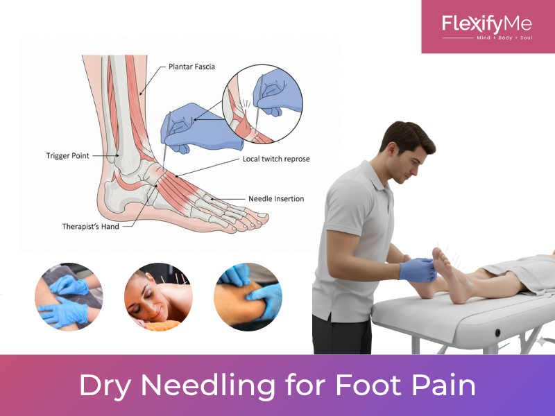 Dry Needling for Foot Pain